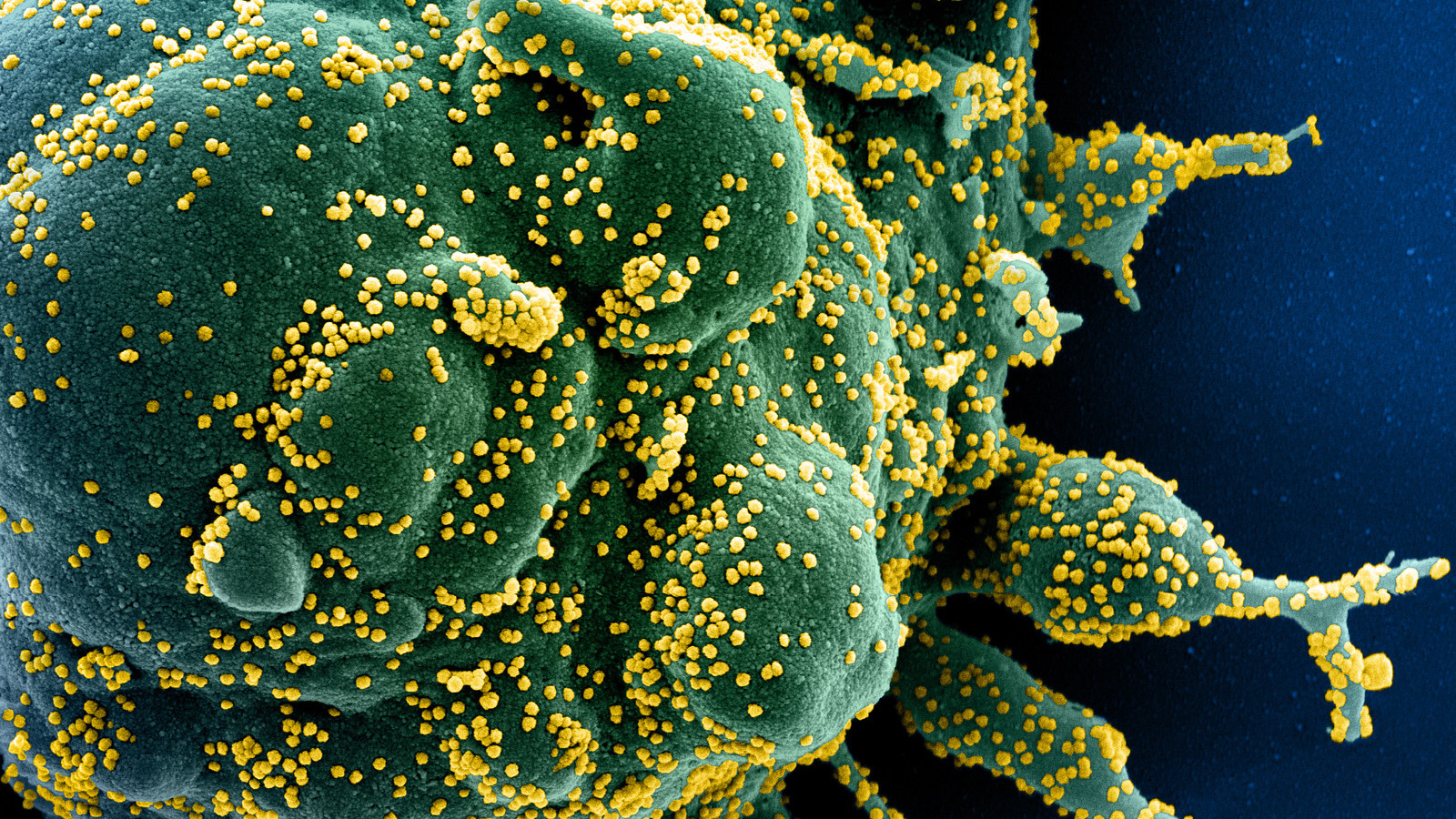 A colourized scanning electron micrograph of a cell, in green, heavily infected with Sars-CoV-2 virus particles (shown in yellow), isolated from a patient sample