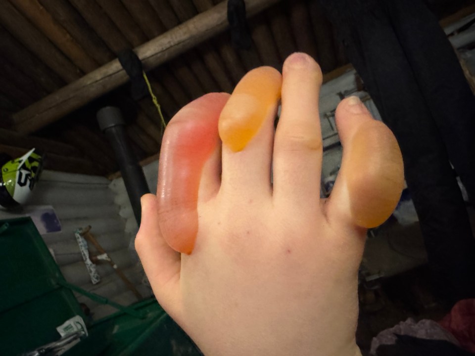 Frostbite on the hand of Avery Groenewegen. Photo: Submitted