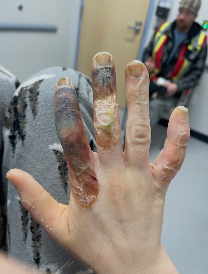 How the frostbite developed over time. Photo: Submitted